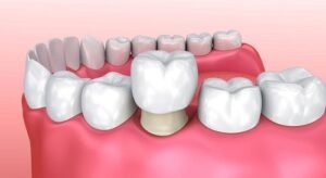Bọc Răng Có Phải Lúc Nào Cũng Cần Thiết? Ai Nên Làm Và Làm Khi Nào?