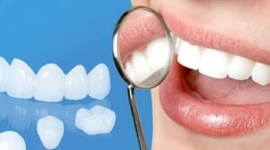 Khi Nào Nên Bọc Răng: Những Trường Hợp Cần Xem Xét