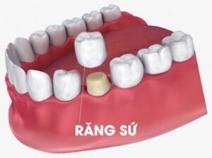 Những lưu ý quan trọng khi bọc răng sứ bạn cần biết