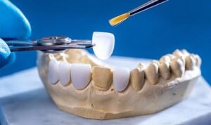 Quy Trình Bọc Răng Thẩm Mỹ: Các Bước Để Có Nụ Cười Hoàn Hảo